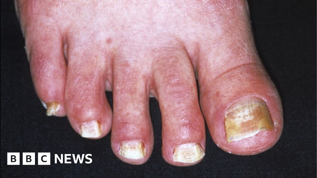 Toenail fungus 'found to be asexual in humans' BBC News