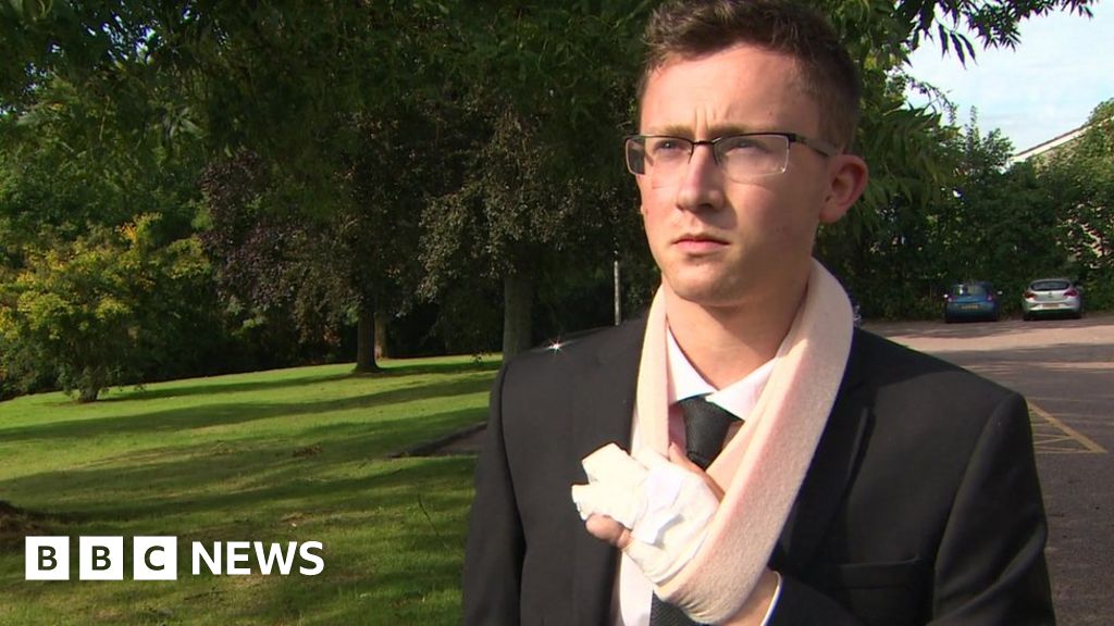 Devon Worker S Crushed Hand Sewn In Abdomen Bbc News Devon Worker S Crushed Hand Sewn In Abdomen Bbc News