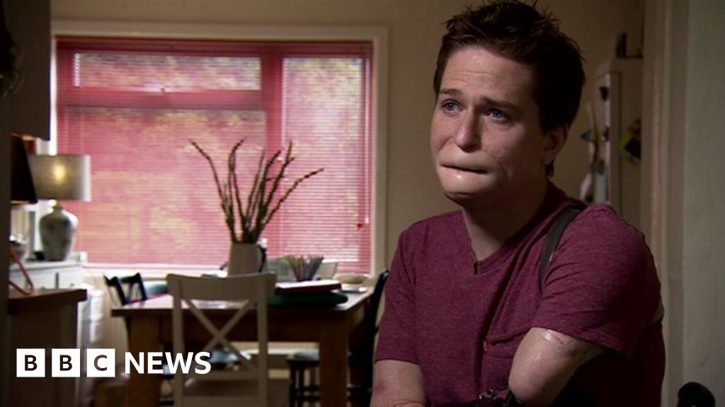 Quadruple Amputee Unable To Get Best Prosthetic Bbc News