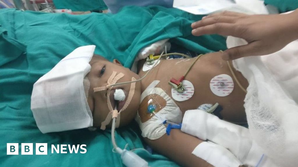 Living a conjoined life - BBC News