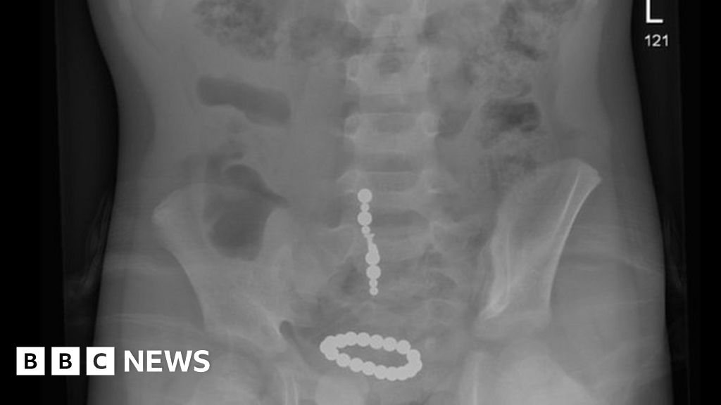 What Happens If You Swallow A Magnet