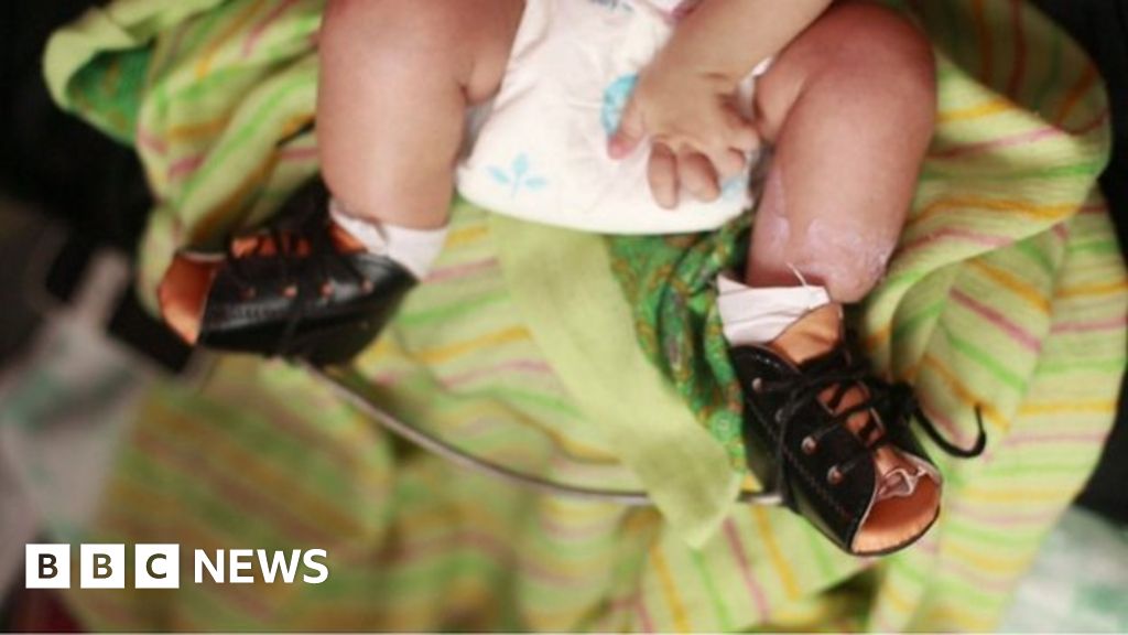 Canvassing Support Helping Children With Clubfoot c News