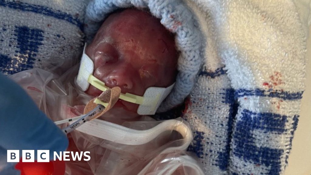 Premature births: Baby born at 22 weeks survives against odds