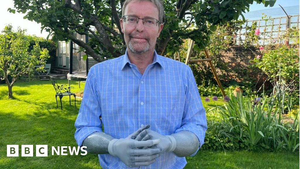 My toes and palms have been amputated after sepsis – MP – BBC Information