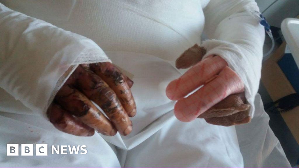 Derbyshire woman turned into a 'human fireball' - BBC News