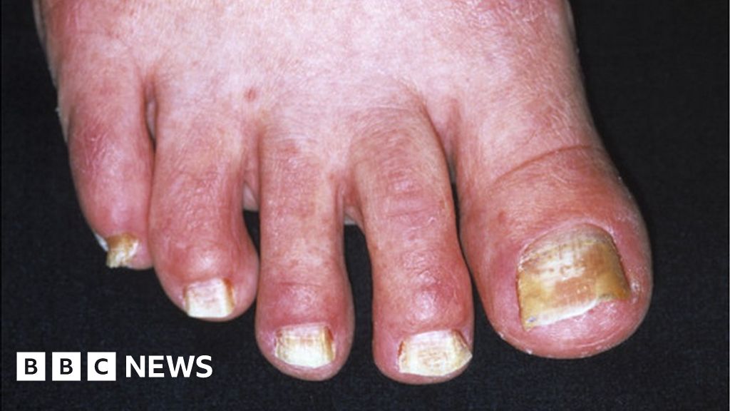 Laser Toenail Fungus Treatment | Podiatrist NYC Downtown | Step Up Footcare