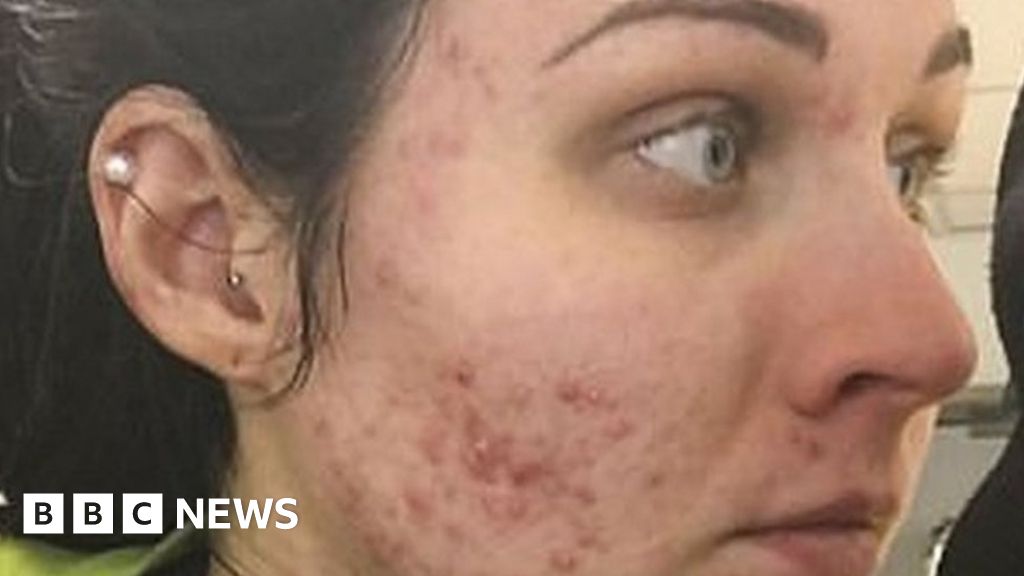 I Woke Up One Day With Severe Acne Bbc News - 