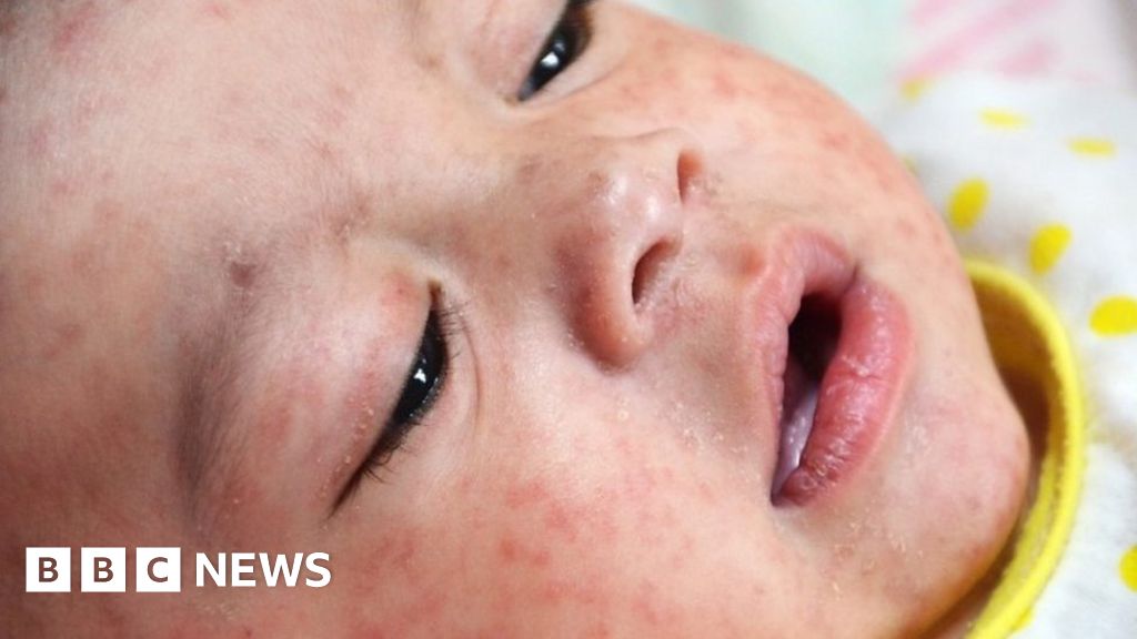 Why Is There A Measles Outbreak In Europe