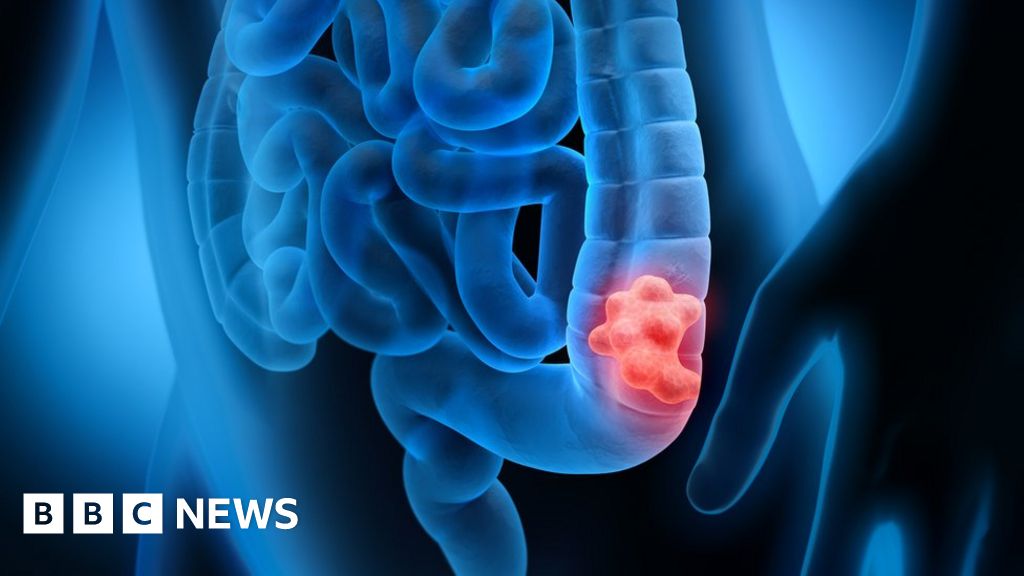 E. coli intestinal infection associated with colon cancer