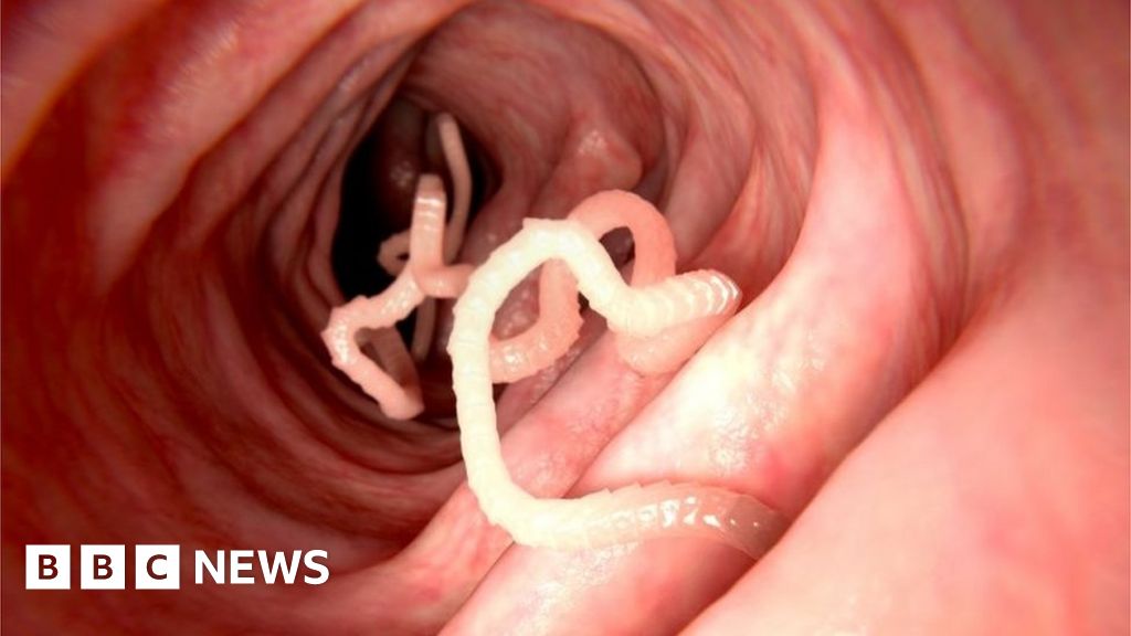 North Korean Defector Found To Have Enormous Parasites Bbc News