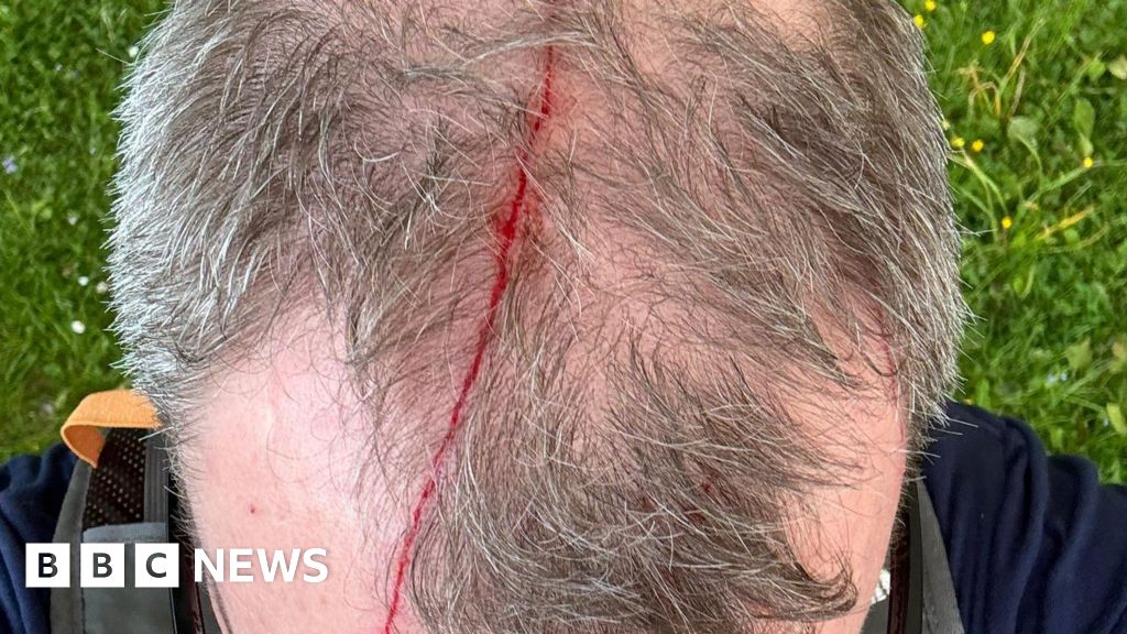 Man 'clonked on head' in swooping buzzard attack