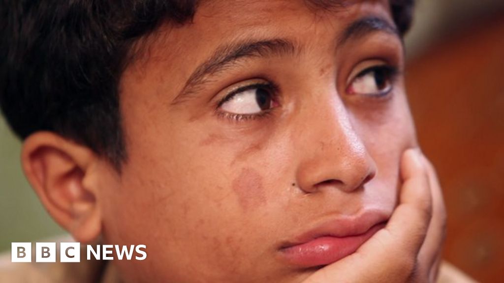 Battle Scars: Gaza Children Living With War's Legacy - BBC News