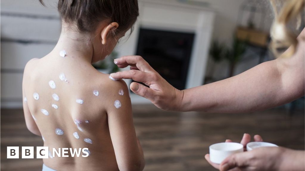 Give toddlers chickenpox jab, advisers tell NHS