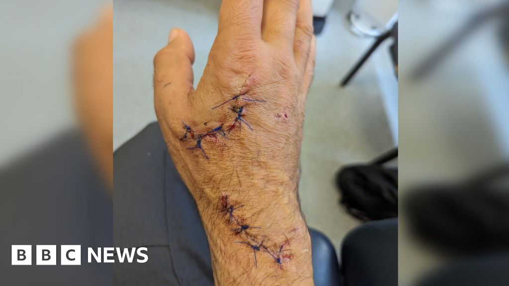 Dog bite victim left ‘anxious and fearful’ – BBC.com