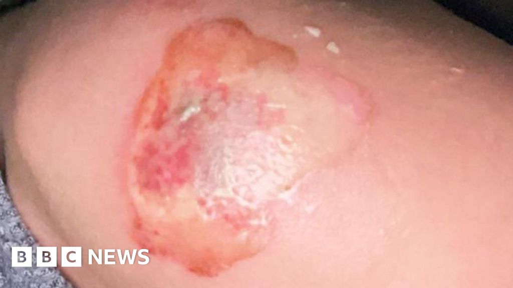 Middlesbrough tanning salon owner jailed over severe burns case