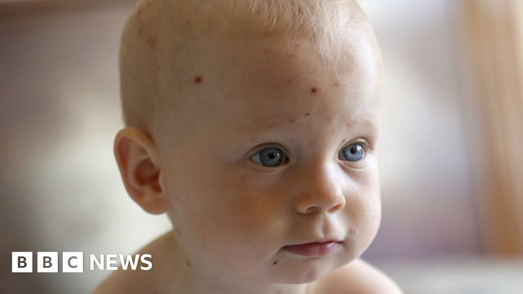 Antivaccine community behind North Carolina chickenpox outbreak