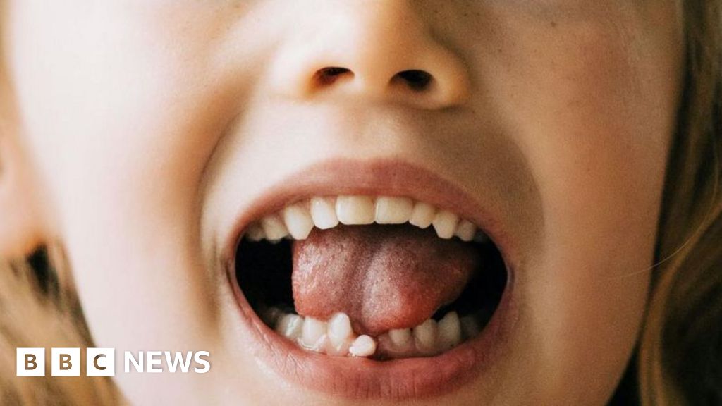 Welsh 999 calls made over loose teeth and broken headphones