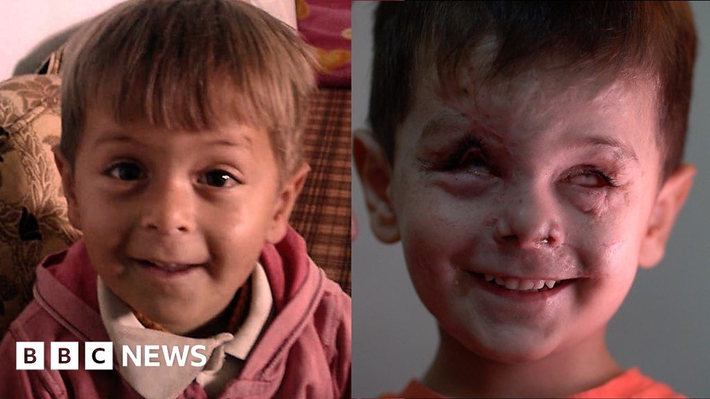 A young face scarred by Syria war