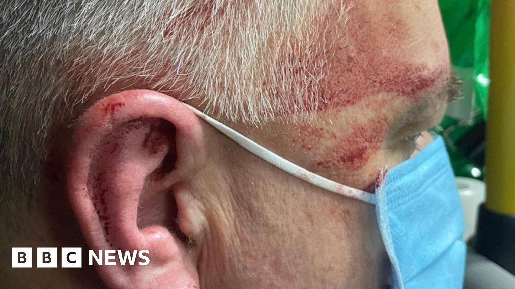 A close up of a man's facial injuries. Mr Raven is wearing a blue medical mask and has cuts to his face.