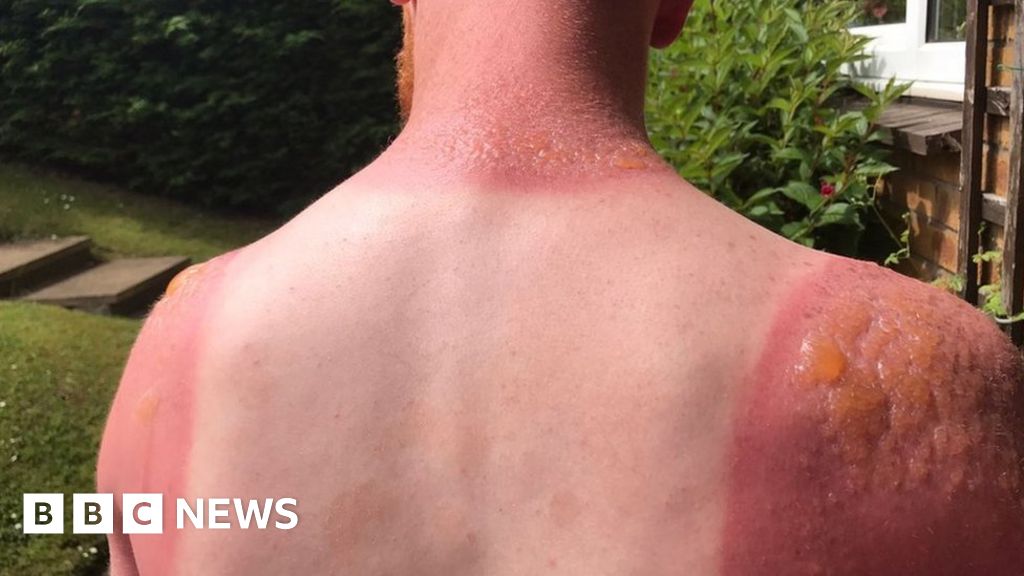Heatwave Leaves Edinburgh Gardener With Second Degree Burns Bbc News 1168