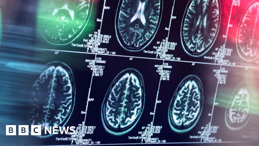 Lecanemab：第一種減緩阿茲海默症的藥物對於 NHS 來說成本太高