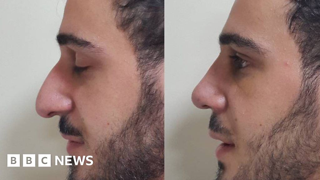 The Middle Eastern men having nose jobs - BBC News