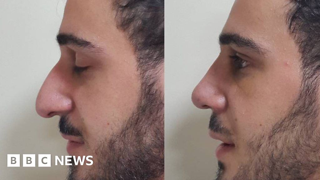 The Middle Eastern Men Having Nose Jobs Bbc News 