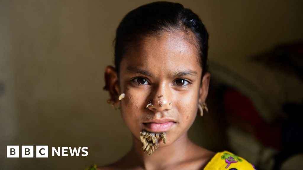 Bangladeshi Girl May Be First Female With Tree Man Syndrome Bbc News