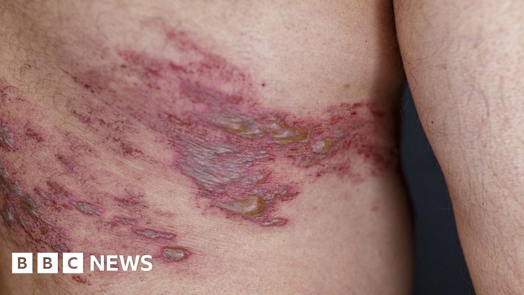 shingles-vaccine-extended-to-vulnerable-over-50s-bbc-news