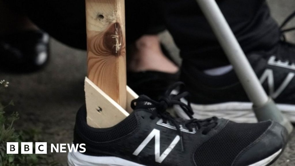 Coronavirus Amputee's wife builds makeshift wooden leg