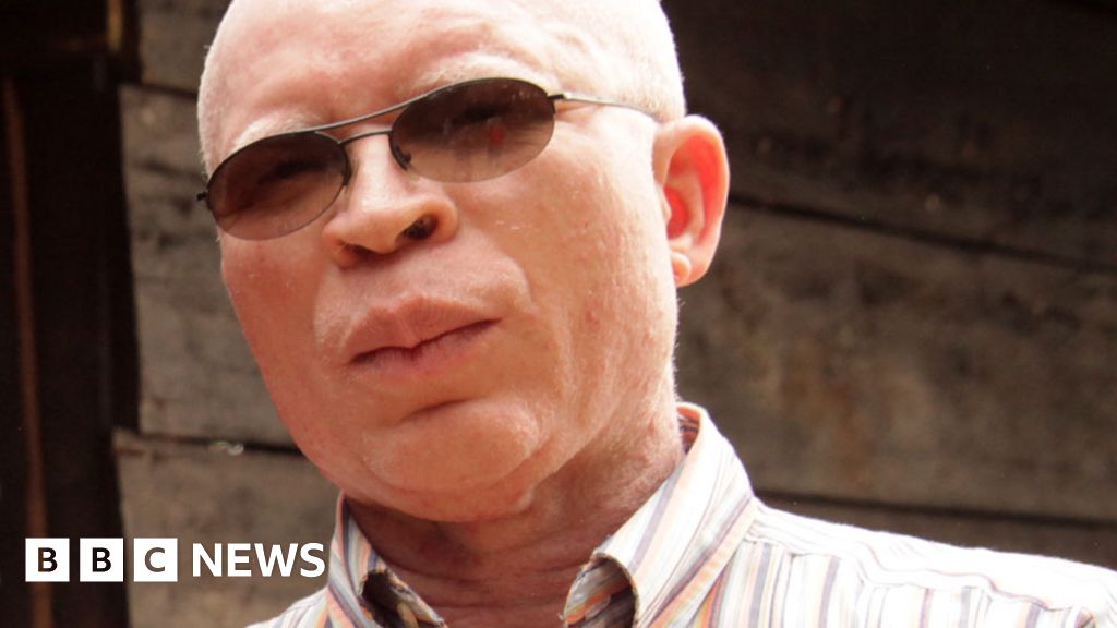 Everything you need to know about albinism