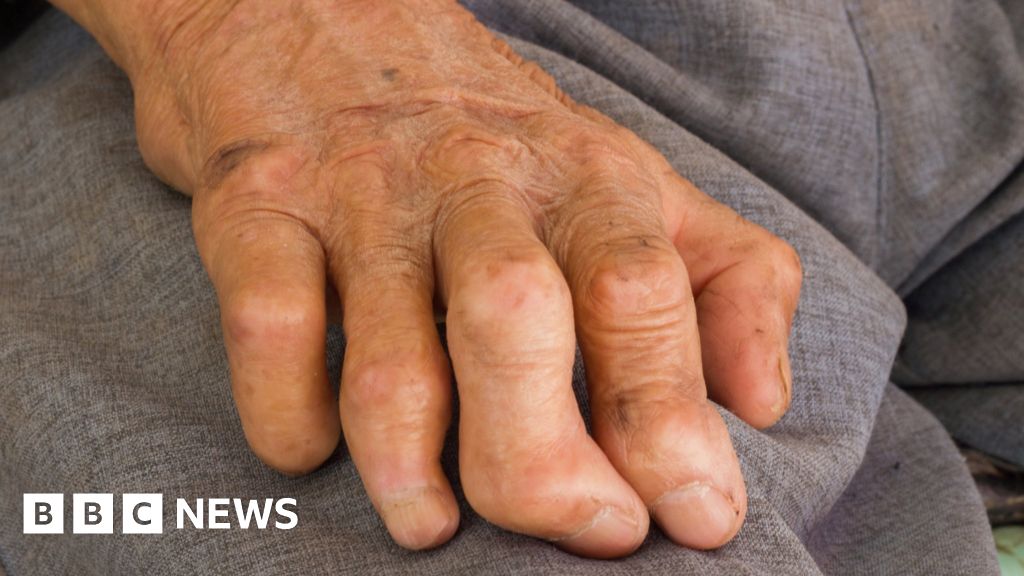 leprosy-ancient-disease-able-to-regenerate-organs