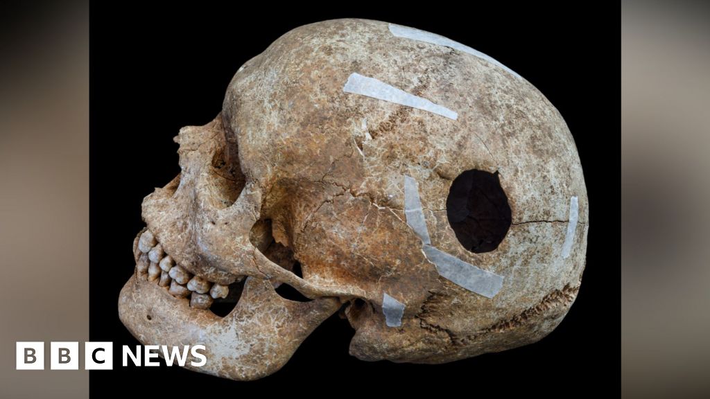 Wandlebury's Viking-era mass grave finds include trepanned skull