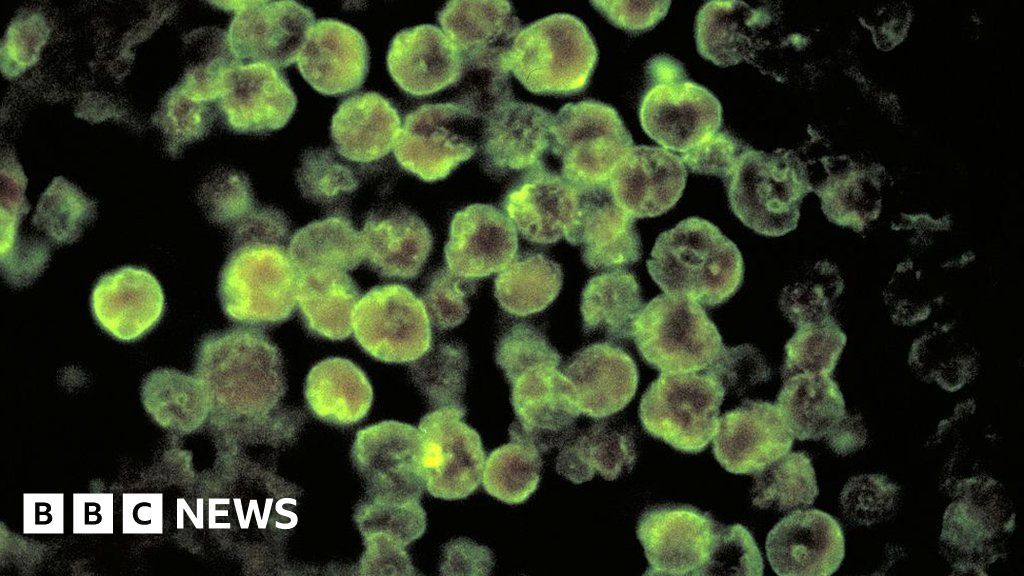 Florida resident dies from brain-eating amoeba