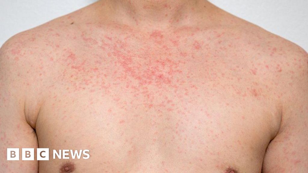 Could Christmas drive up West Midlands measles cases?