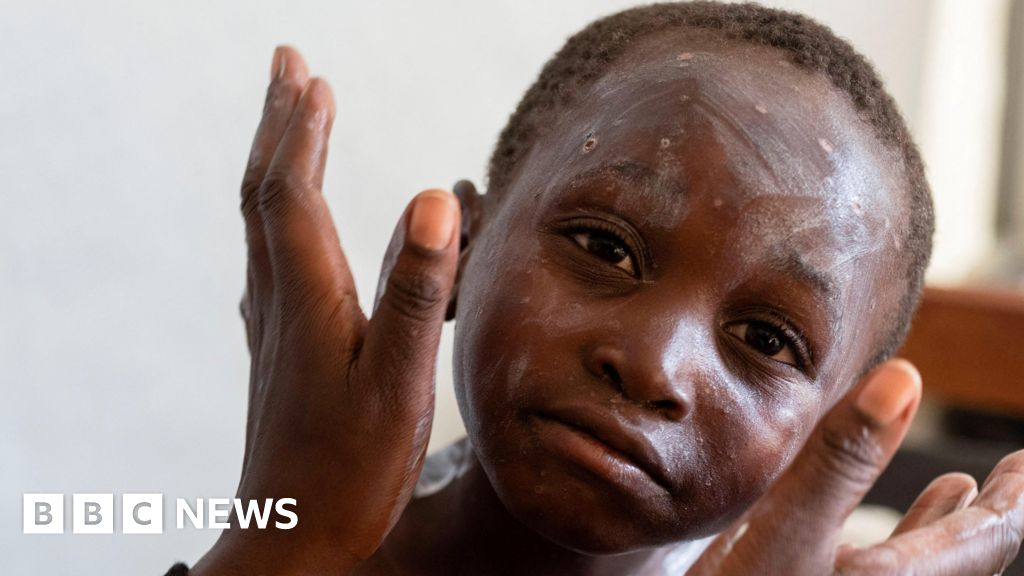 How worried should we be about mpox?