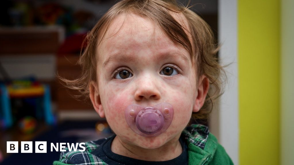 Warning measles could hit tens of thousands in London