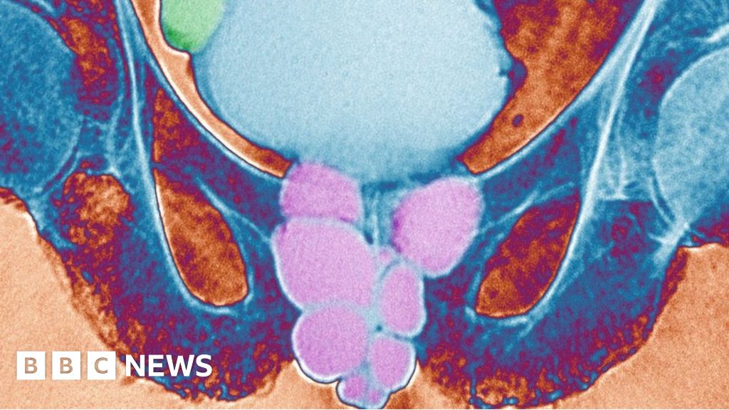 ce este prostatita la un barbat? ecografia prostata preparacion