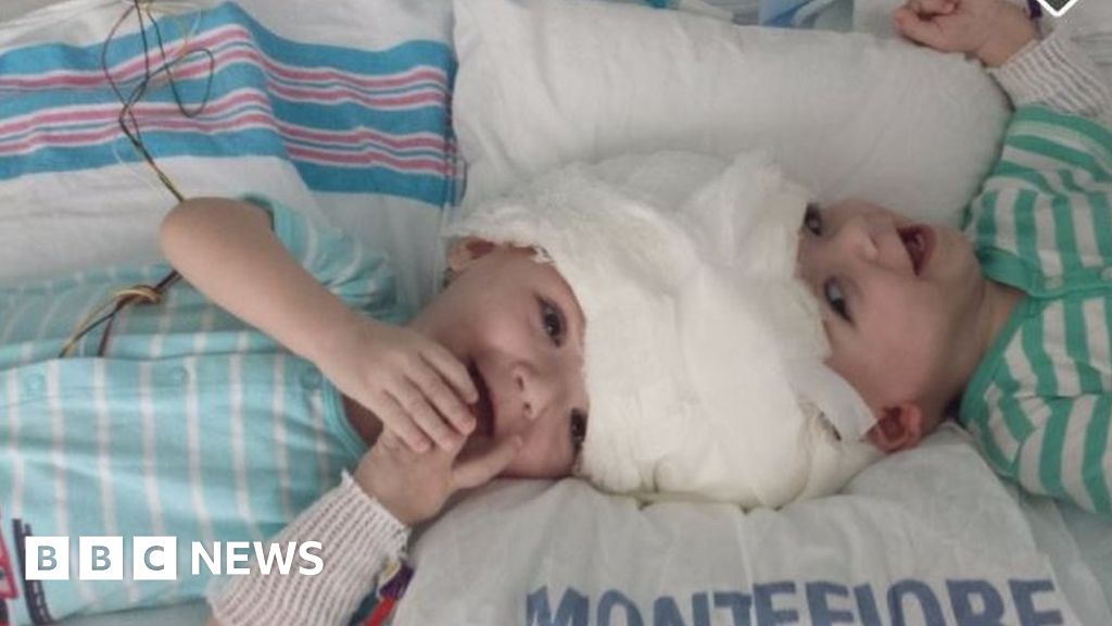 Surgeons In New York Separate Twins Conjoined At The Head Bbc News
