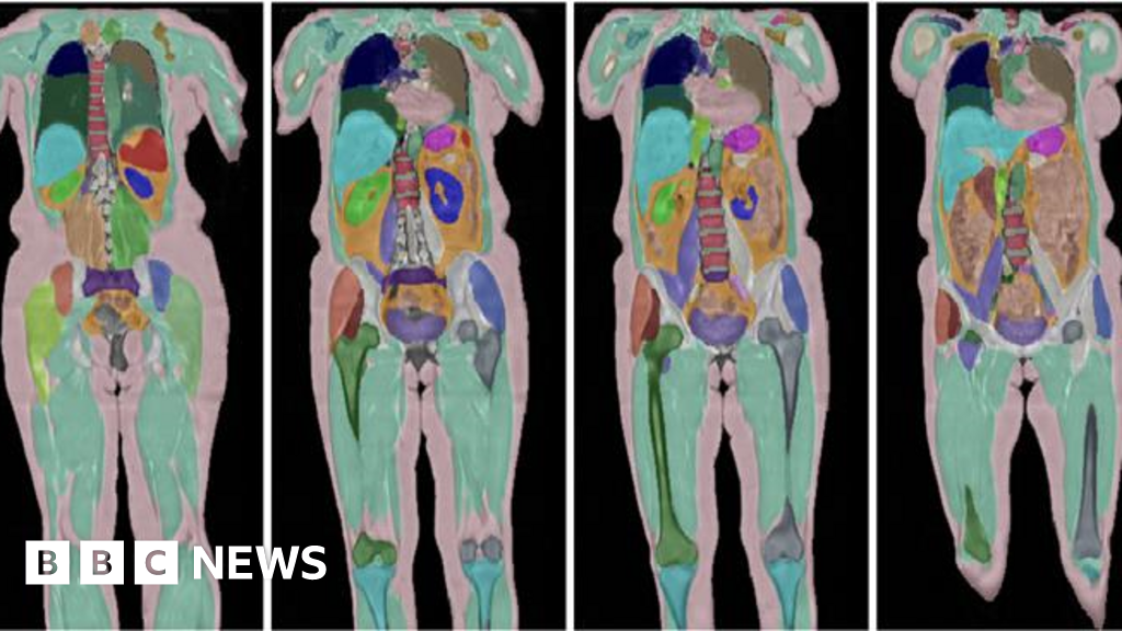 Biggest human imaging study scans 100,000th UK volunteer thumbnail