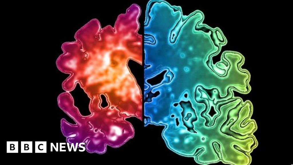 The Drug To Slow Alzheimer's? - BBC News