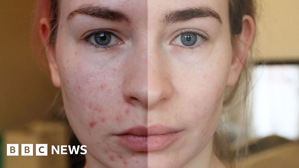 Lack of skin specialists causes delays for acne patients, says ...