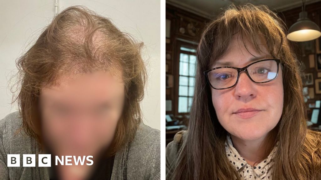 Stoke-on-Trent woman met fellow hair-pulling sufferers through stand-up