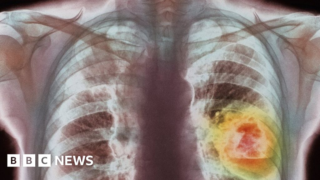 Рак легкого симптомы сколько живут. Онкологические заболевания легких. Пороки развития дыхательной системы у человека.