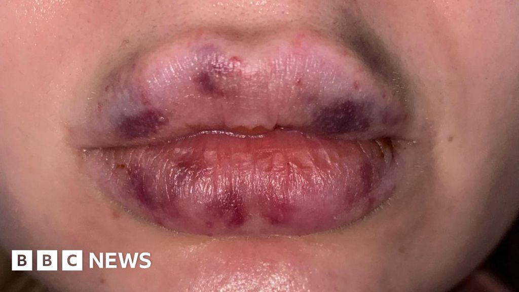 Lockdown Lip Fillers Gone Wrong My Lips Went Black Bbc News