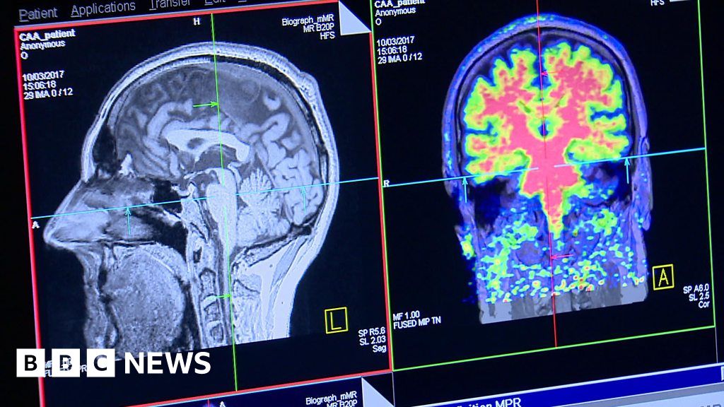 New scanner could aid stroke and dementia diagnosis - BBC News