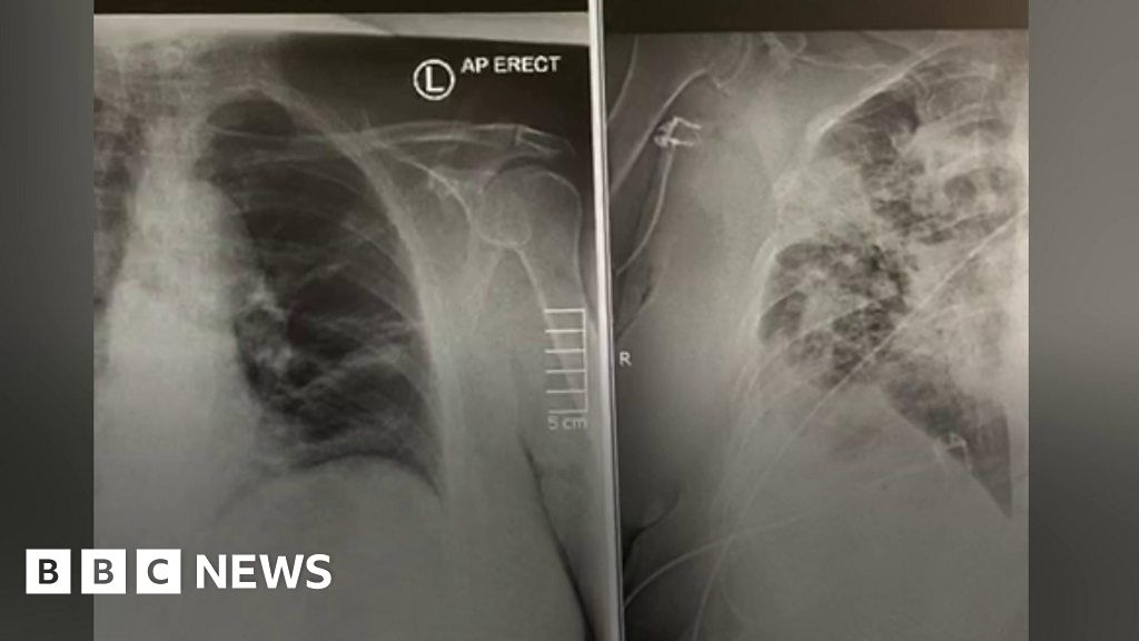Covid-19: Doctor's video diary of life on a respiratory ward - BBC News