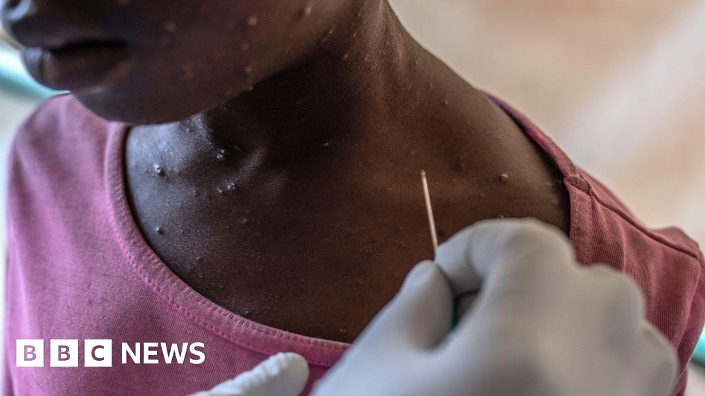 No cause for concern over mpox - health chiefs