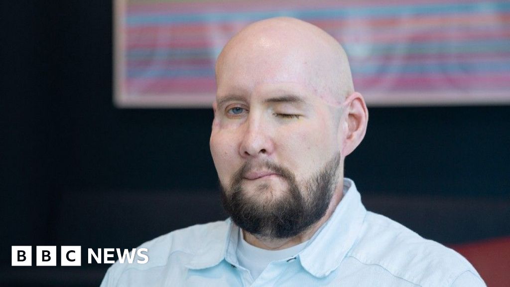 US Veteran Recovering from Historic Eye Transplant