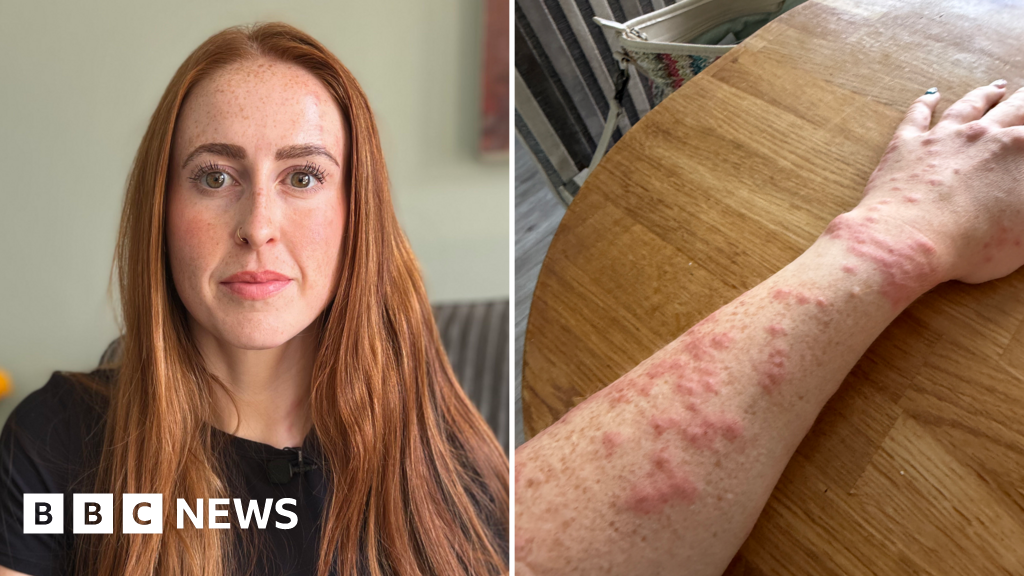 Woman attacked by bed bugs during Travelodge stay